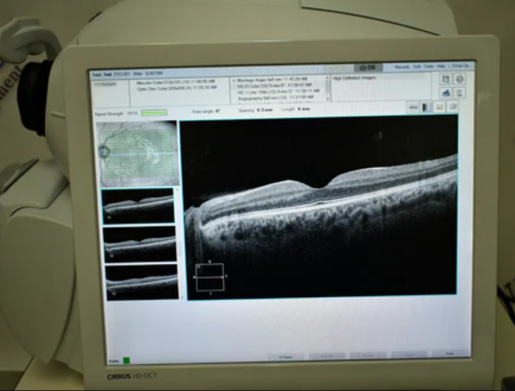 Carl Zeiss Cirrus 5000 HD-OCT